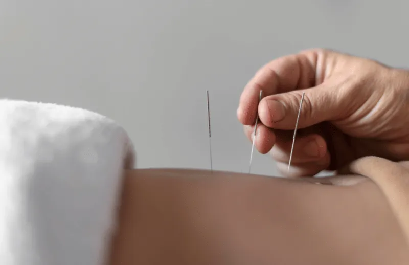 Placing dry needles in the lower back during a session in West Boca Raton