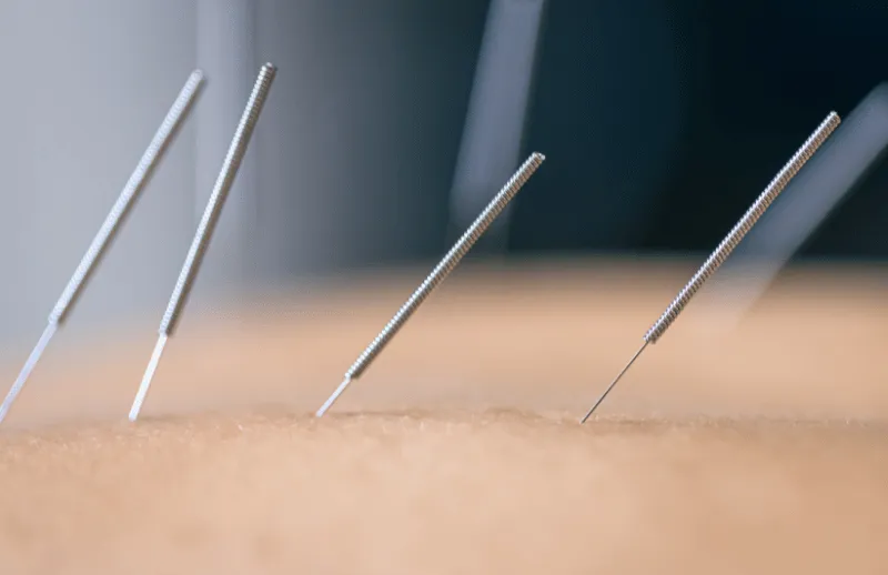 Thin filament needles placed in a trigger point during dry needling